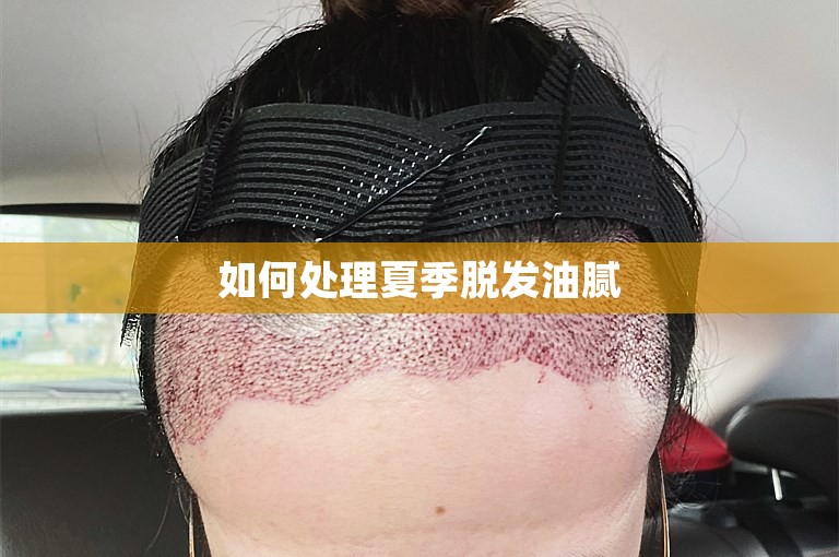 如何处理夏季脱发油腻