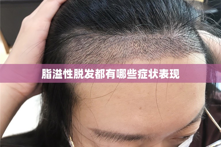 脂溢性脱发都有哪些症状表现