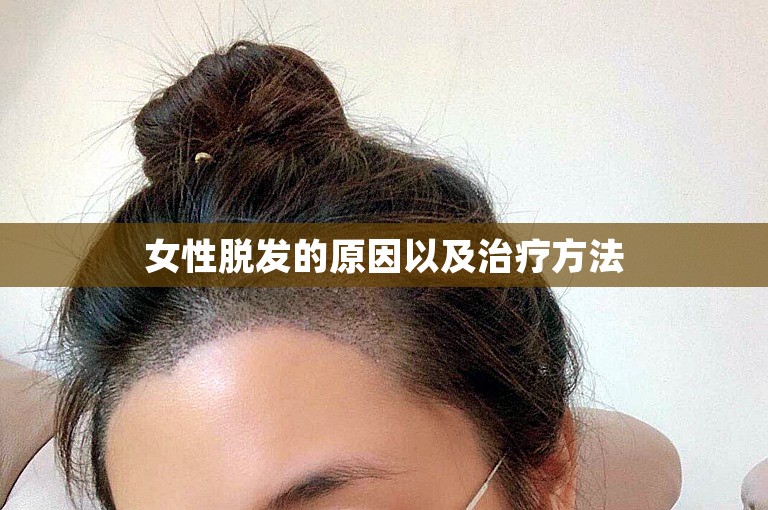 女性脱发的原因以及治疗方法