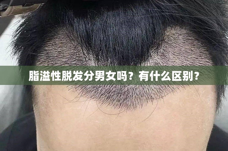 脂溢性脱发分男女吗？有什么区别？