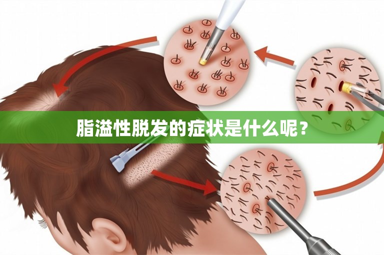 脂溢性脱发的症状是什么呢？