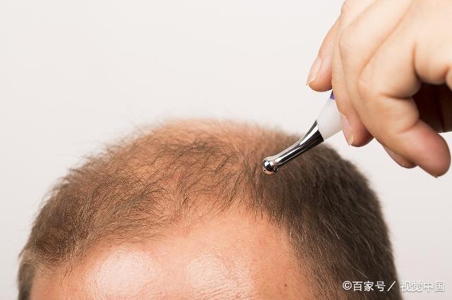 每6个中国人中就有1人脱发，植发市场千亿规模待开发