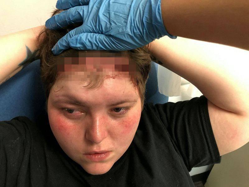 女孩花2千元接头发1个月后头皮严重出血