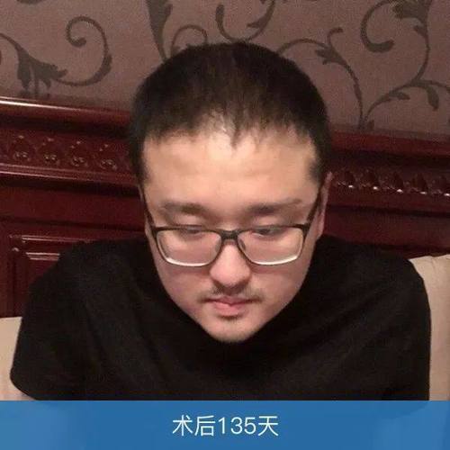 笑笑孙亚龙脱发笑笑植发孙亚龙植发