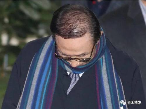 韩国前总统李明博秃顶他不是植发了吗？