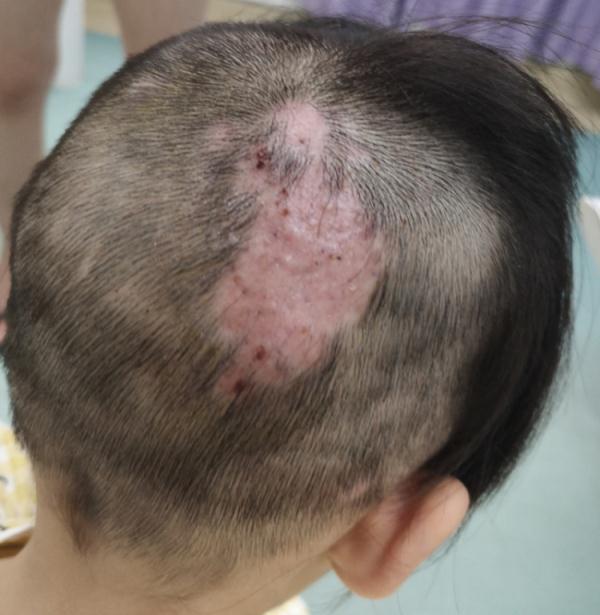 6岁女童突然“秃头”！近期接诊5例，与它有关！专家提醒
