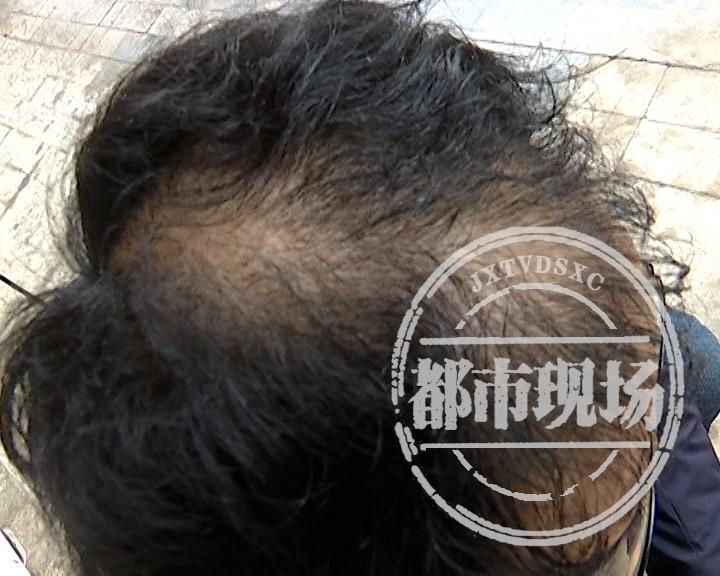 “95后”男子花了近4万植发，依然“头秃”，植发机构竟称达到了承诺的效果？