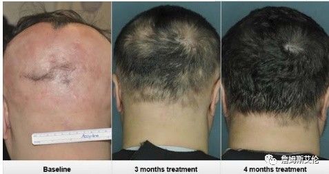 FDA批准JAK抑制剂治疗严重斑秃，JAK抑制剂治疗斑秃的效果