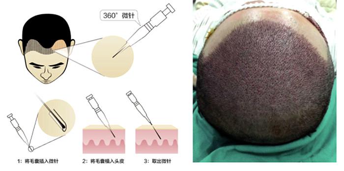 新生植发TDDP-I微针植发：喇叭口提取毛囊不伤发，效果更好