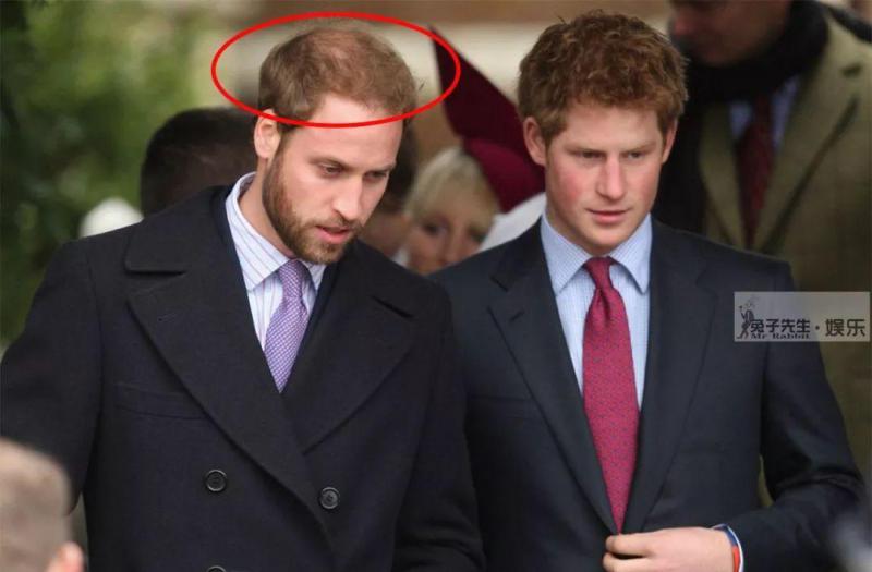 34岁哈里王子蓄起胡须， 竟是为了植发！ 和哥哥一样秃顶 