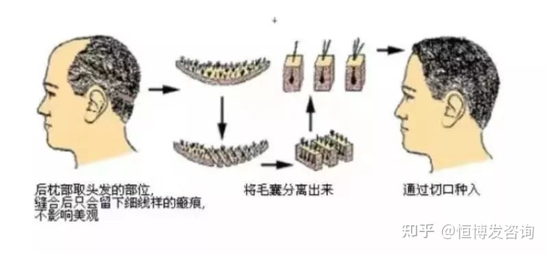 青岛植发去哪家医院做得好？从植发医院、技术、价格来讲