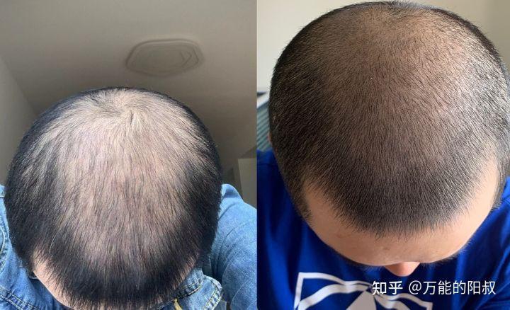 杭州植发有哪些比较靠谱的植发医院和医生？