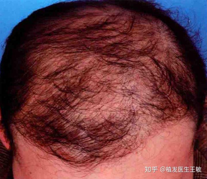 植发几年后居然出现了断层？植发医院医院有排名？