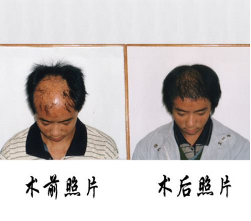深圳治疗脱发的医院哪家好？
