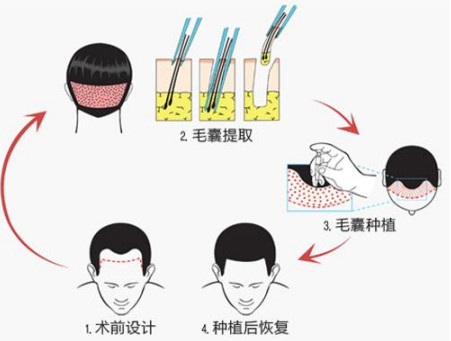 宁波哪里可以进行疤痕头发种植