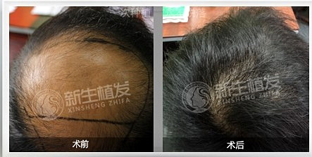 杭州更好的植发医院是哪个？