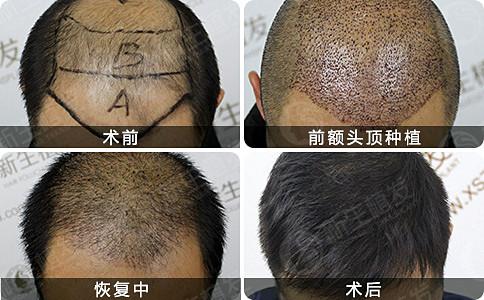 在广州植发医院植发后还会有脱发的风险吗？