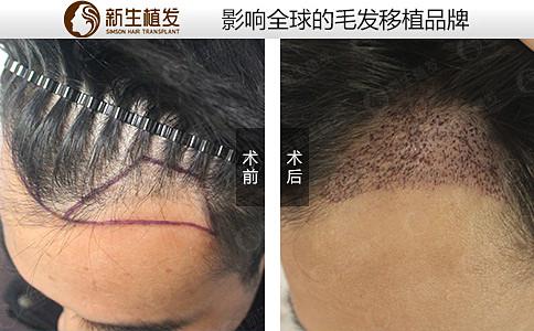 上海地区的植发医院毛发种植好吗