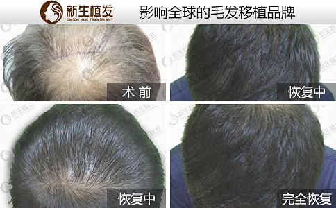 广州头发种植选择哪家医院好？