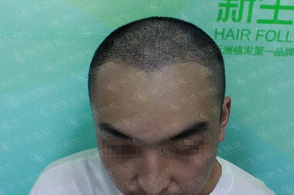 广州新生植发医院植发好不好，看专家怎么说