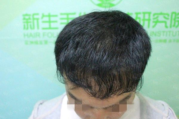 广州新生植发医院植发好不好，看专家怎么说