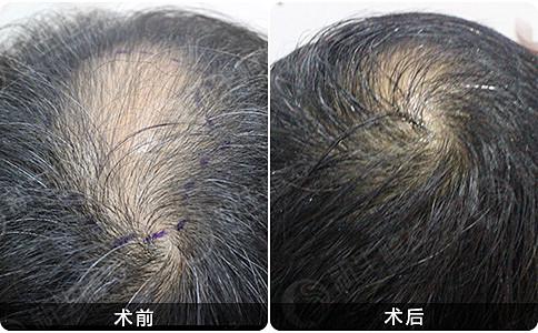 上海新生植发医院植发效果真的有那么好吗？