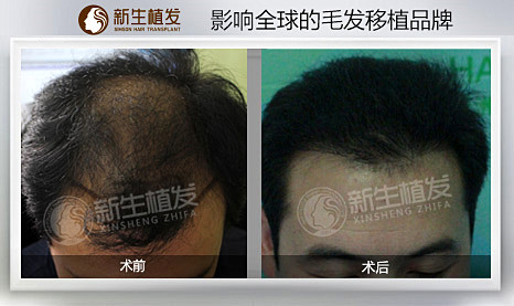 广州治疗脂溢性脱发较好的医院？