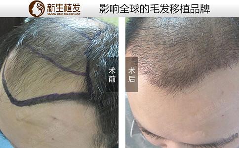 上海新生植发医院种植发际线手术可靠吗？