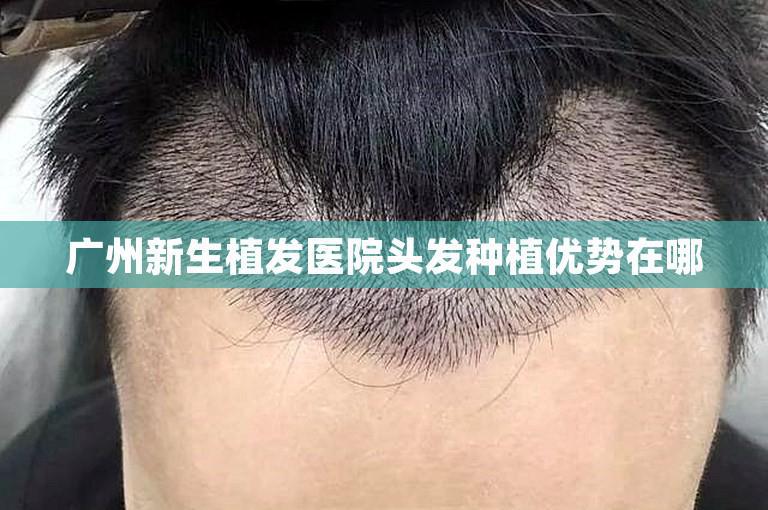 广州新生植发医院头发种植优势在哪