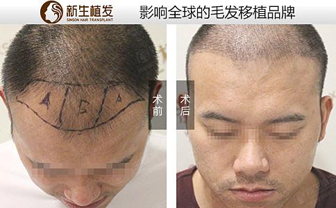 广州头发种植医院哪个好