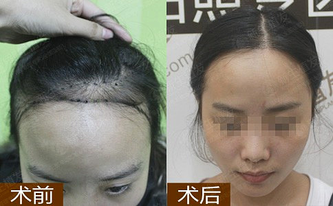 广州植发医院怎么治疗男性脱发？