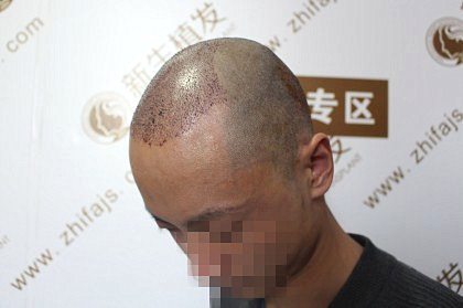 杭州新生植发医院植发效果如何，植发患者告诉你