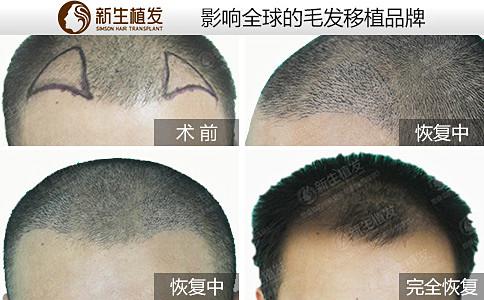上海新生植发医院的植发效果真的好么