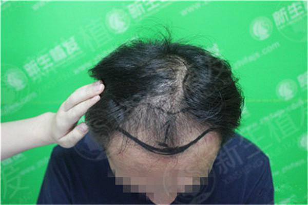 杭州市头发种植较好的医院是哪家