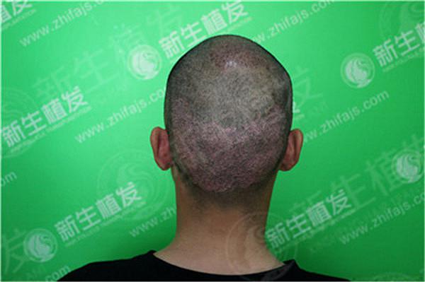 南京种植毛发医院的植发效果怎么样