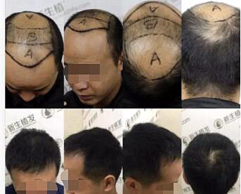 南京有没有好的头发种植医院？南京新生植发医院用真正案例说话