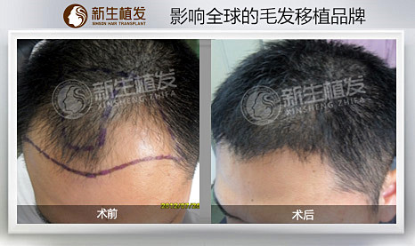 在南京怎样选择好的植发医院？
