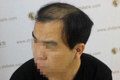 杭州新生植发解决秃顶危机