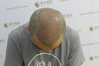 杭州新生植发解决秃顶危机