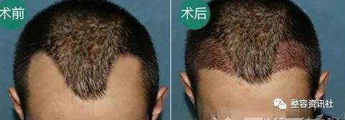 广州倍生植发医院植发能保持多久？