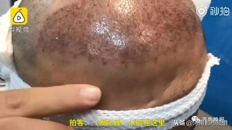 90后已经走上植发之路！94年小伙被父母催着植发：秃了以后相亲受阻