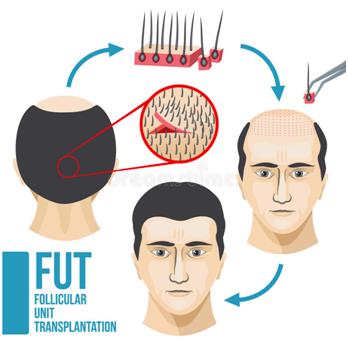 fut植发的优势和劣势，植发前必须知道的那些事