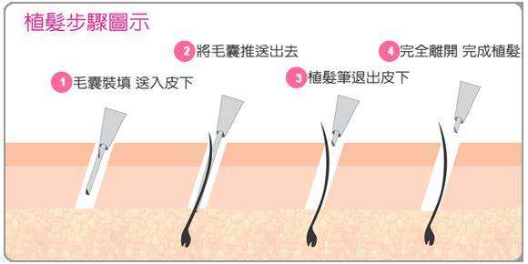 植发种植笔，现代医学的进步成果