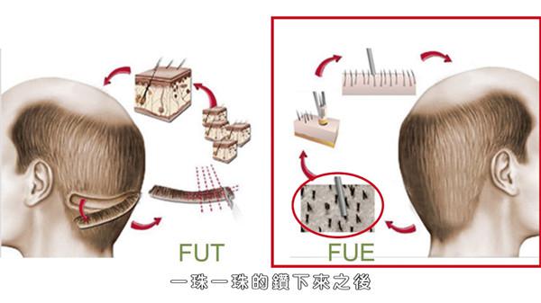 植发自然吗？植发会不会看起来很明显