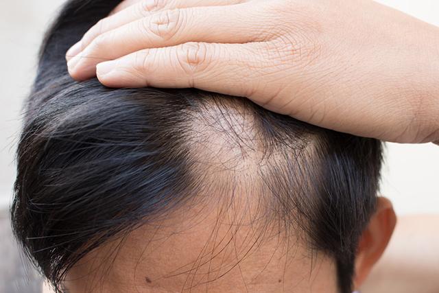 影响毛囊成活率的因素有哪些
