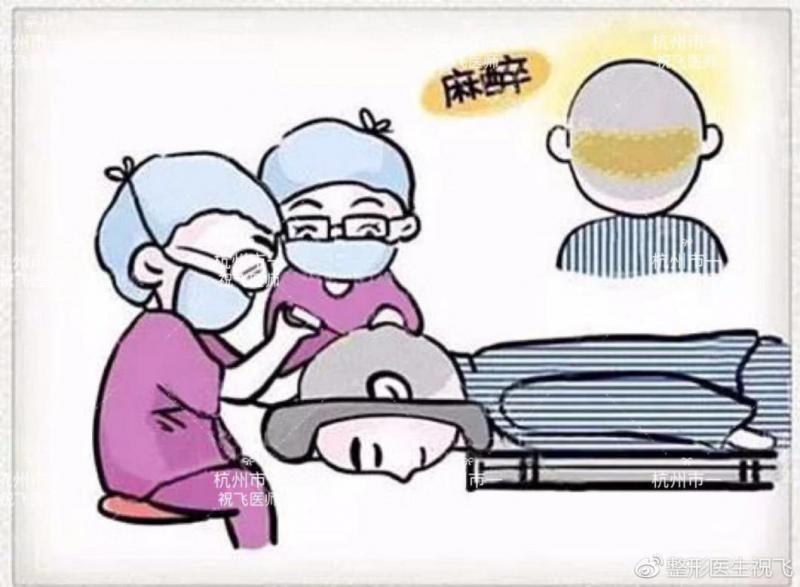 杭州市祝飞医生讲解FUE植发手术全过程