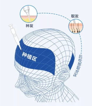 为什么植发手术效果会有差别？