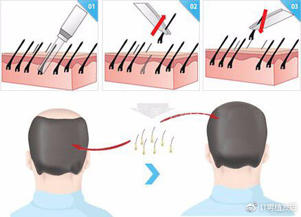 植发取毛囊后脑勺取毁了这句话并不准确