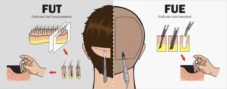整个植发的变迁史也是人类智慧的进化史！