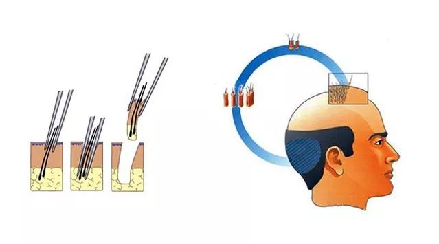 毛囊提取对后枕部有啥影响？